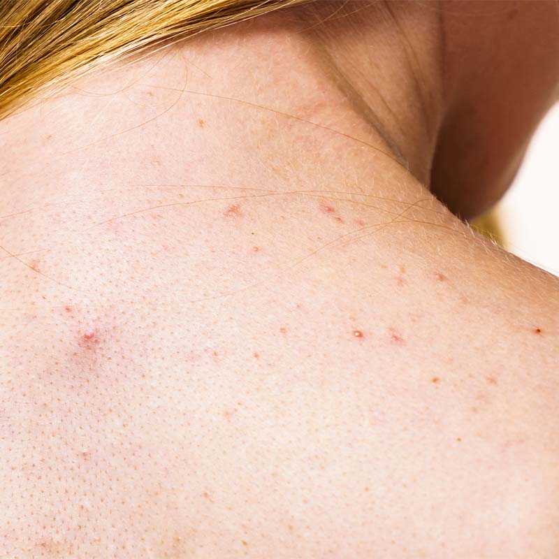 woman with back acne