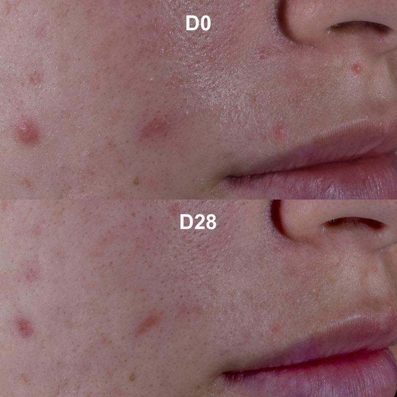 Before/after Kerato+