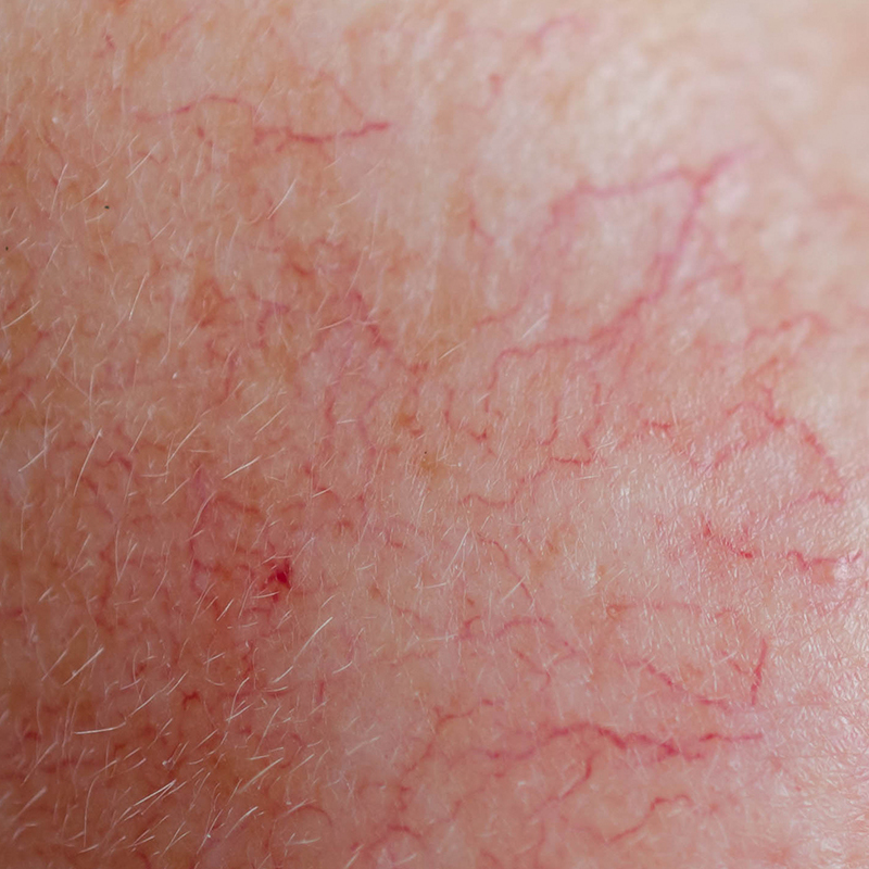 Close-up of facial skin showing persistent redness