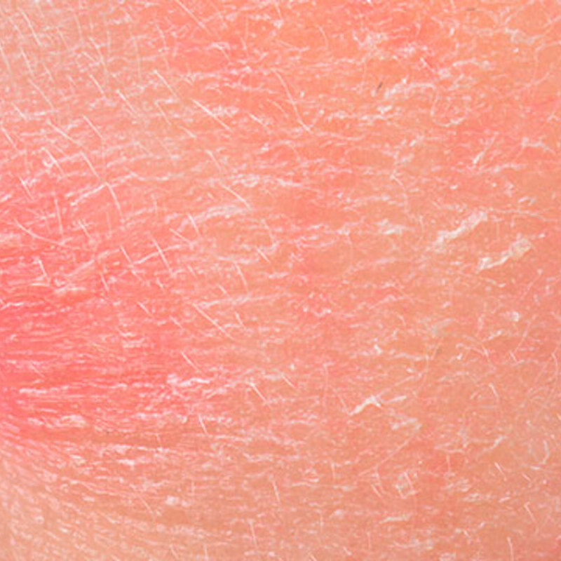 Sensitive skin image